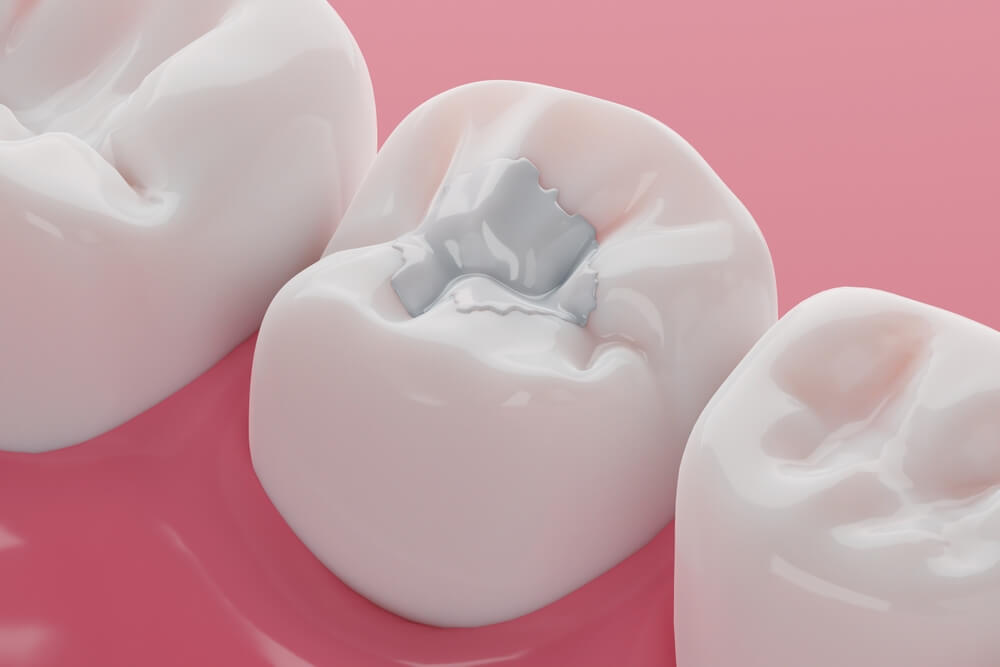 tooth filling