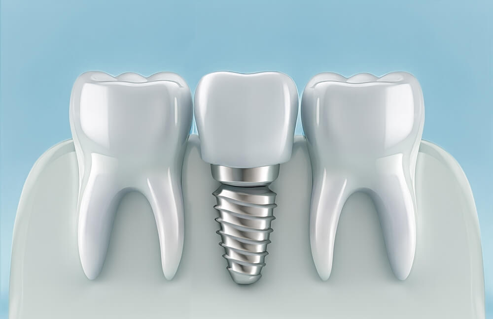 dental implant model